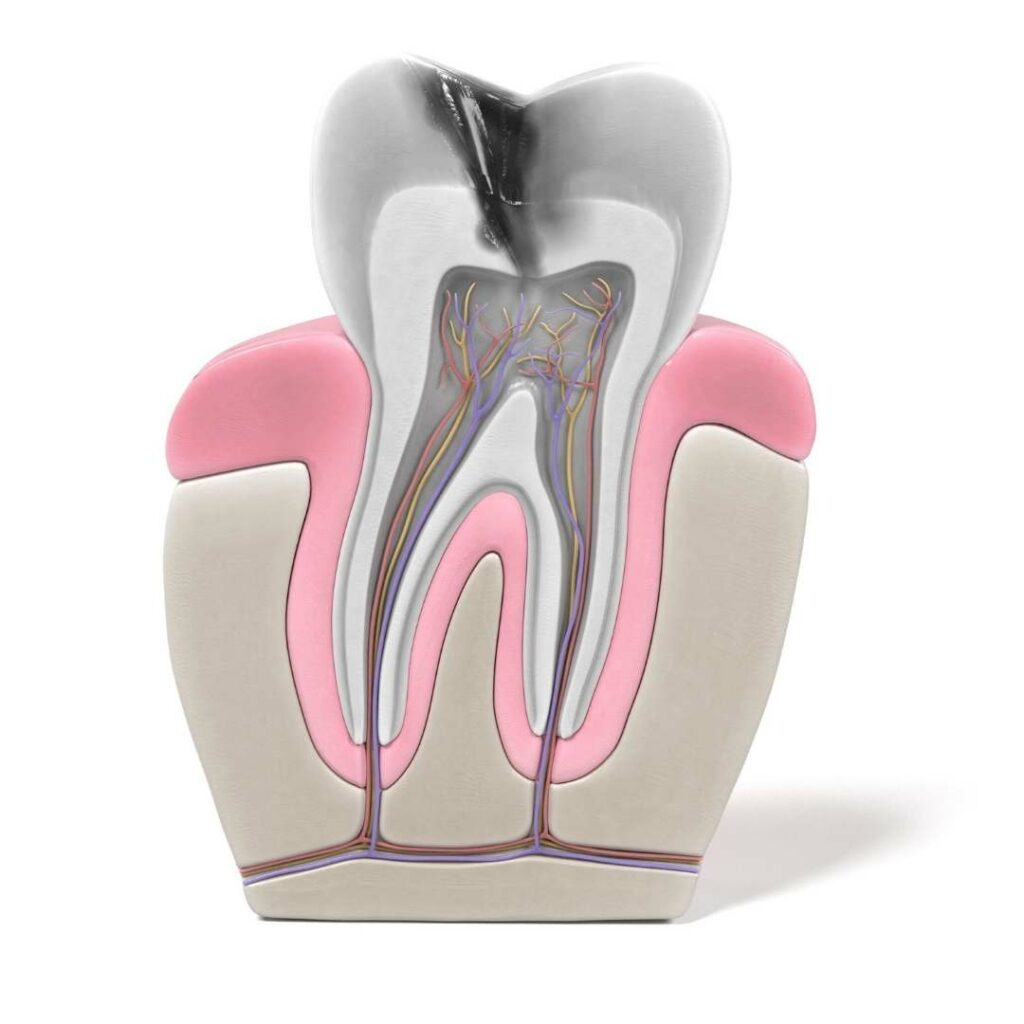 Facts about root canal treatment