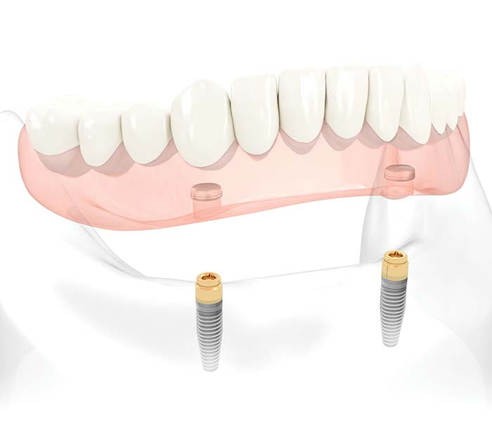 snap on dentures with locator implant