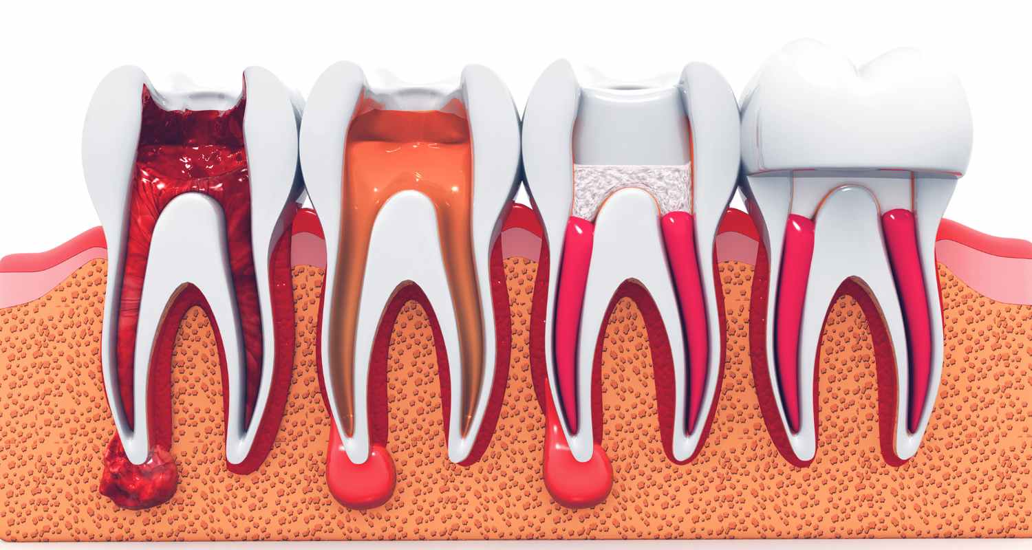 Root Canal: Myths, Facts, and Aftercare