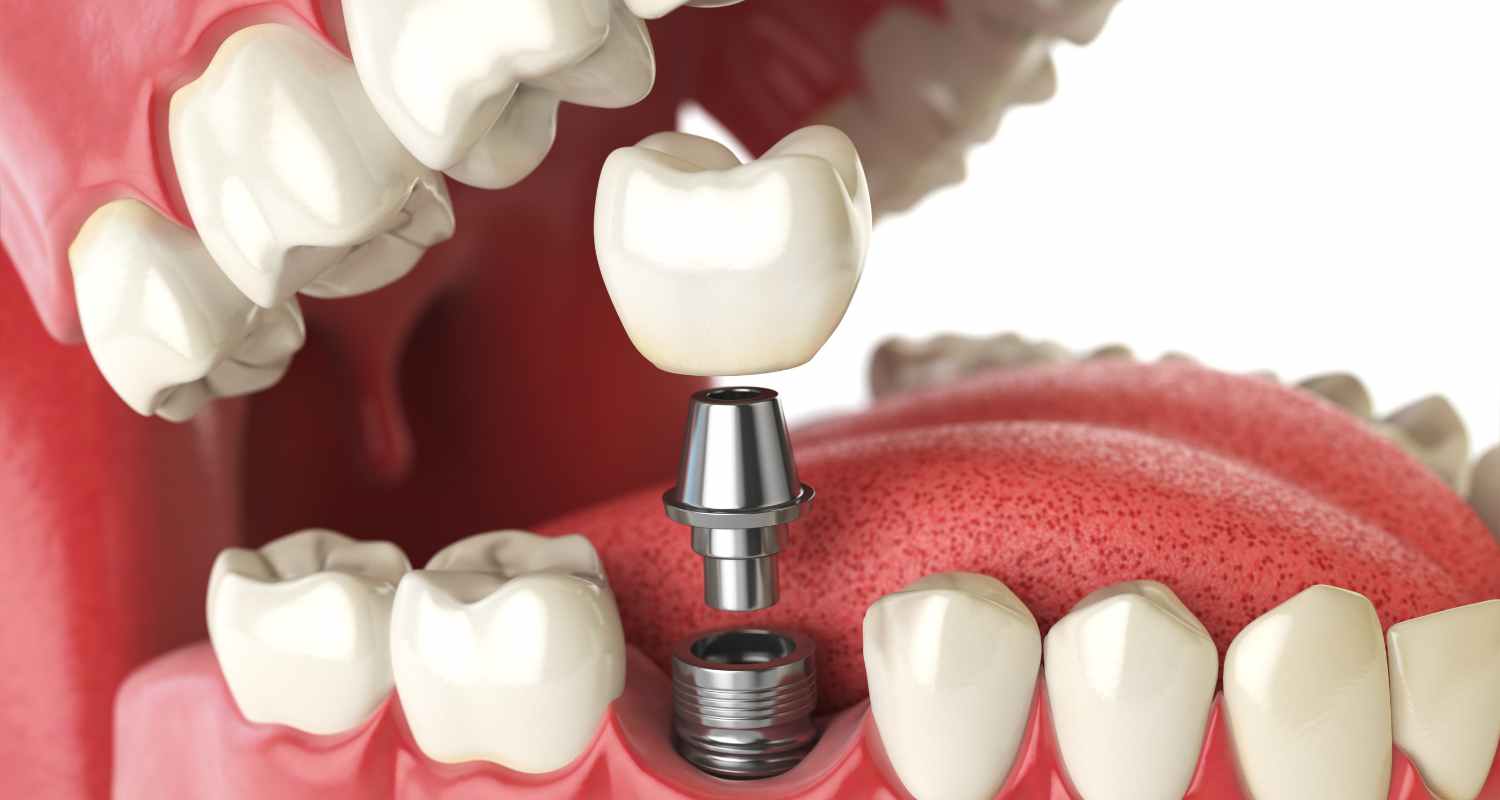 dental implants