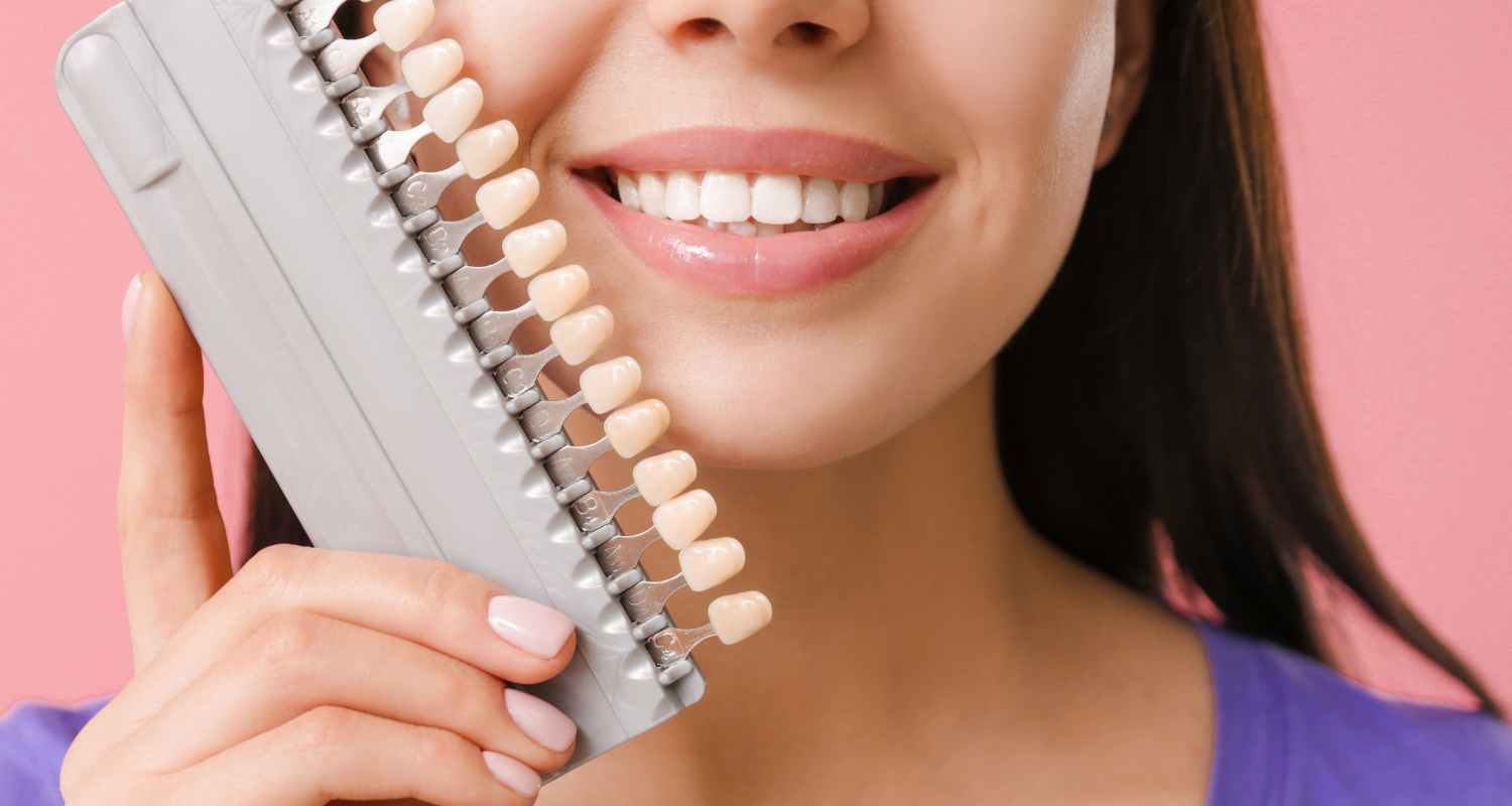 Dental Veneers